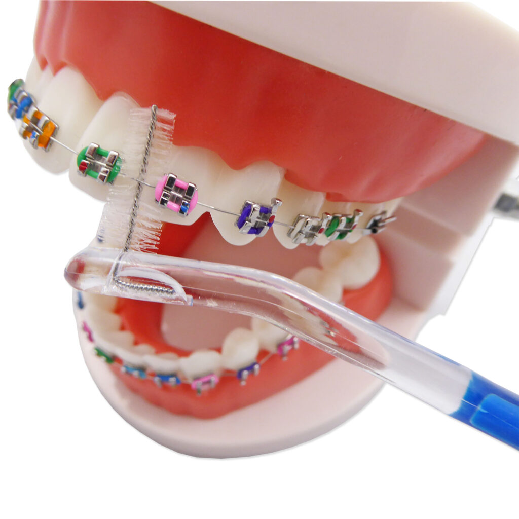 Orthodontic Toothbrush Cleaning Around Braces